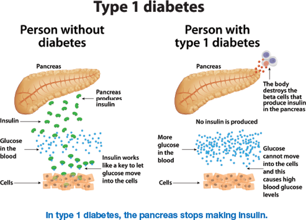 In type 1 diabetes, the pancreas cannot make insulin. This happens because the body’s immune system destroys the beta cells in the pancreas. It is the beta cells that make insulin. This results in too much glucose, or sugar, in the bloodstream. If you have type 1 diabetes, you have to replace the insulin your body can no longer make. Insulin is given by injection or by using an insulin pump.  The exact cause of type 1 diabetes is not yet known. Currently, nothing can be done to prevent or cure type 1 diabetes, but researchers are working on this. If type 1 diabetes is managed well, you can continue to lead a healthy life.