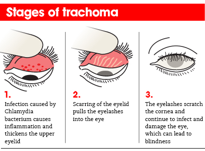  India has eliminated Trachoma 