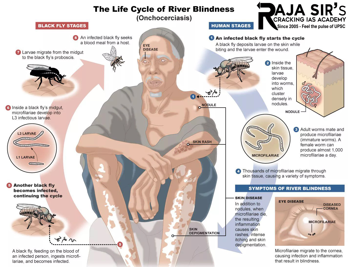 Onchocerciasis